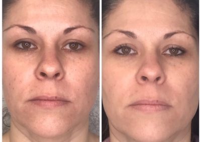 Before and after Skin Irregularity Treatment
