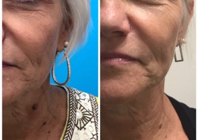 Before and after Skin Irregularity Treatment Keratosis (1 treatment)