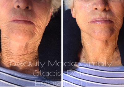 Before and after XO8 Stem Cell Facial (1 treatment)