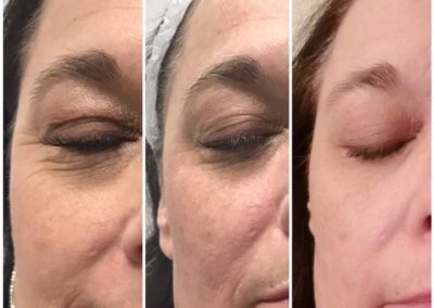 Before and after Skin Irregularity Treatment Keratosis (1 treatment)