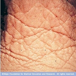 glycation of the skin