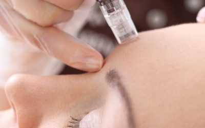 Stretch Marks Begone! An Introduction to the Benefits of Microneedling for Stretch Marks