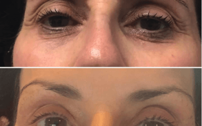 5 Most Frequently Asked Questions About Fibroblast Treatment