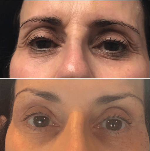 benefits of fibroblast skin tightening