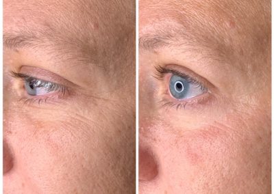 BioRevitalization before and after