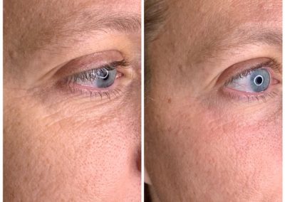 BioRevitalization before and after