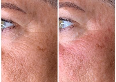 BioRevitalization results