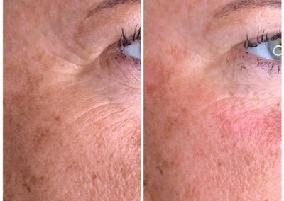 before and after BioRevitalization