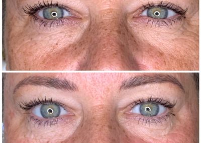 before and after BioRevitalization treatment