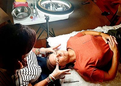 biorevitalization peel before