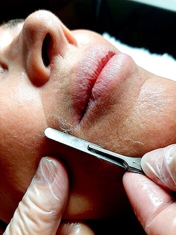 dermaplaning