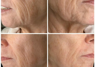 Before and After 1 skin resurfacing treatment