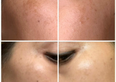 Before and after 1 skin resurfacing treatment for Melasma