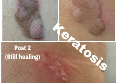 Skin resurfacing treatment for Keratosis